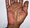 Palmar erythema often called liver palm in Southeast Asian, Myanmar woman. Royalty Free Stock Photo