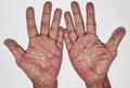 Palmar erythema often called liver palm in Southeast Asian, Myanmar woman. Royalty Free Stock Photo