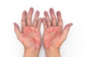 Palmar erythema often called liver palms in both hands of Southeast Asian, Myanmar man Royalty Free Stock Photo