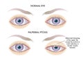 Palpebral ptosis