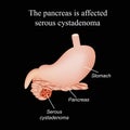 The pancreas is affected serous cystadenoma. Vector illustration on a black background