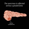 The pancreas is affected serous cystadenoma. Vector illustration on a black background