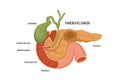 Pancreas cancer. Human cancer