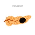 Pancreas disease and cancer