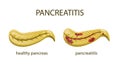 Pancreas healthy and pancreatitis Royalty Free Stock Photo