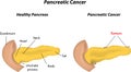 Pancreatic Cancer