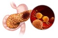 Pancreatic Cancer Anatomy Royalty Free Stock Photo