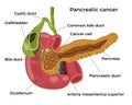 pancreatic cancer stages pancreas medical poster anatomy