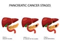 pancreatic cancer stages pancreas medical poster