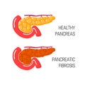 Pancreatic fibrosis concept. Vector illustration