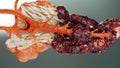 Pancreatic illness, digestive gland, Human pancreas cancer anatomy diagram, medically accurate, malignant tumor growing Royalty Free Stock Photo