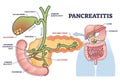 Pancreatitis as pancreas inflammation from chronic gallstones outline diagram Royalty Free Stock Photo