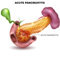 Pancreatitis Royalty Free Stock Photo