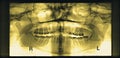 Full mouth dental xray (x-ray)