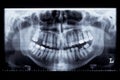 Panorama x-ray image of a human jaw Royalty Free Stock Photo