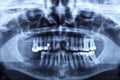 Panorama x-ray image of a human jaw