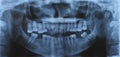 Panoramic dental and mandible x-ray