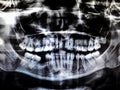 Panoramic dental tooth X-ray. Radiography for dental structures research concept Royalty Free Stock Photo