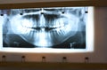 Panoramic Dental X-ray