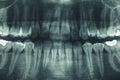 Panoramic dental X-Ray