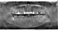 Panoramic dental X-Ray