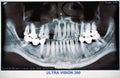 Panoramic Dental X-Ray with broken tooth