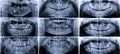 Panoramic dental x-ray Royalty Free Stock Photo