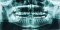 Panoramic Dental X-Ray Royalty Free Stock Photo