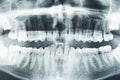 Panoramic Dental X-Ray Royalty Free Stock Photo