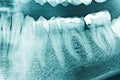 Panoramic Dental X-Ray Royalty Free Stock Photo