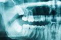 Panoramic Dental X-Ray Royalty Free Stock Photo
