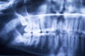 Panoramic Dental X-Ray Of Human Teeth Royalty Free Stock Photo