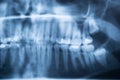 Panoramic Dental X-Ray Of Human Teeth Royalty Free Stock Photo