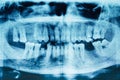 Panoramic dental x-ray image of teeth. Detail. Royalty Free Stock Photo