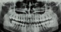 Panoramic dental X-ray - one wisdom teeth missing