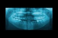 Panoramic dental X-Ray for Orthodontics