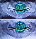 Panoramic dental X-ray picture in 2 versions with pain image of the frond teeth