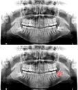 Panoramic dental X-Ray. Scan Tooth