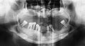 Panoramic dental X-Ray.