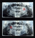 Panoramic dental x-ray with superior upper wisdom tooth (eight