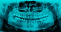 Panoramic dental X-ray - 31 teeth cyan color