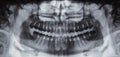 Panoramic dental X-ray - 31 teeth