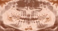 Panoramic dental X-ray - 32 teeth