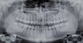 Panoramic dental X-ray - 32 teeth - 4 wisdom Royalty Free Stock Photo