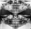 Panoramic dental Xray, fixed teeth, dental amalgam seal, wisdom tooth on side, horizontally impacte