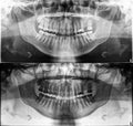 Panoramic dental Xray, fixed teeth, dental amalgam seal, dental crown and bridge, filled root canal wisdom tooth impacted Royalty Free Stock Photo