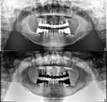 Panoramic dental Xray, fixed teeth, dental amalgam seal, dental crown and bridge,