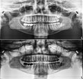 Panoramic dental Xray, fixed teeth, dental amalgam seal, wisdom teeth on side, horizontally impacted