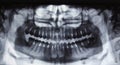 Panoramic dental Xray