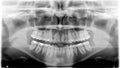 Panoramic dental Xray Royalty Free Stock Photo